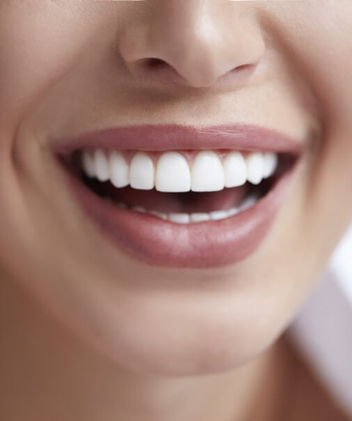 Closeup of smile after permanent smile enhancement with porcelain veneers