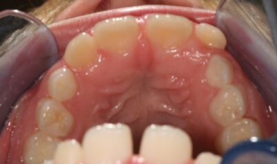 Misaligned bottom teeth before orthodontic treatment