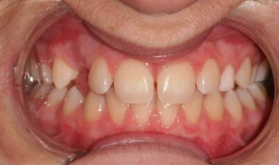 Smile with missing tooth before dental treatment