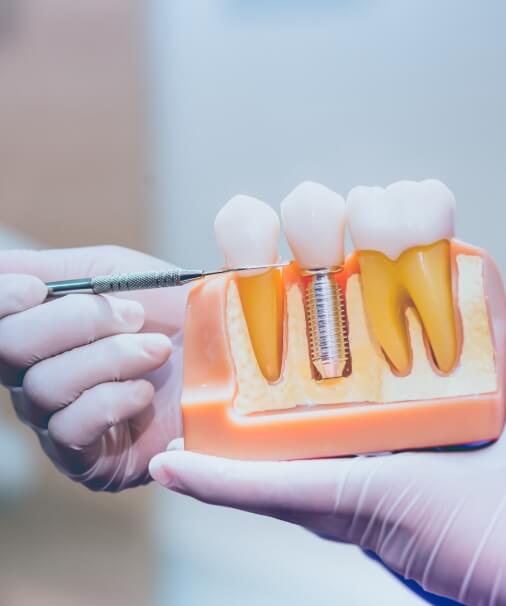 Model used to explain the four step dental implant process
