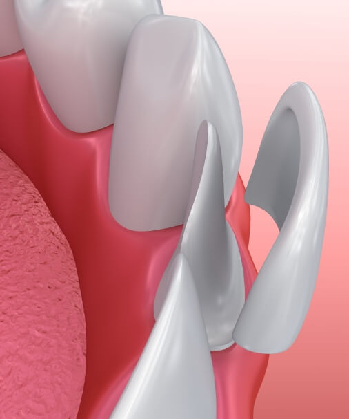 Animated smile during porcelain veneer placement