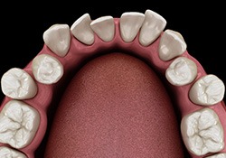 Illustration of gapped teeth