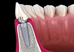 Side-view illustration of dental implant in jawbone