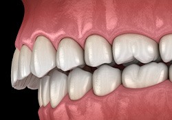 Illustration of an overbite