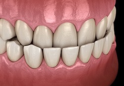 Illustration of an underbite