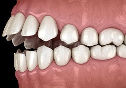Illustration of an open bite