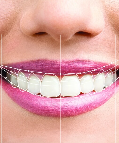 Digital smile evaluation software showing treatment plan over patient's smile