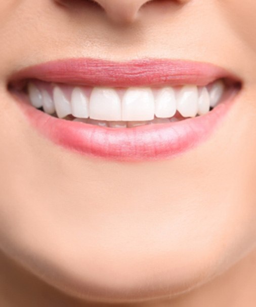 Close-up of a patient’s smile after cosmetic dental bonding in Newbury Park, CA