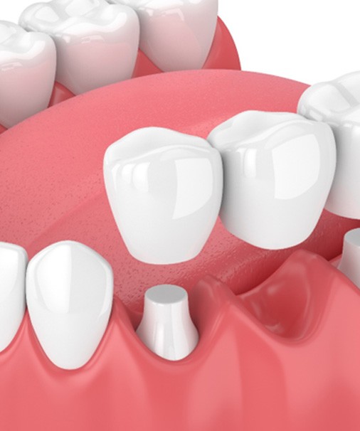 digital illustration of a dental bridge