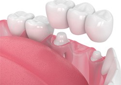 regular dental bridge being placed in mouth