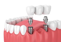 digital rendering of a dental implant bridge