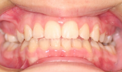 Aligned smile after orthodontic treatment
