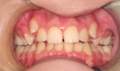 Crooked smile before orthodontic treatment