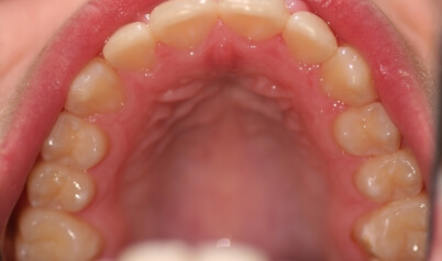 Aligned bottom teeth after orthdontic treatment