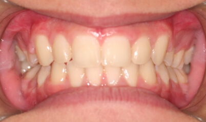 Smile with corrected bite after orthodontic treatment