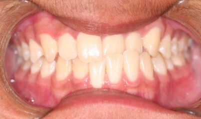 Smile with crossbite before orthodontic treatment