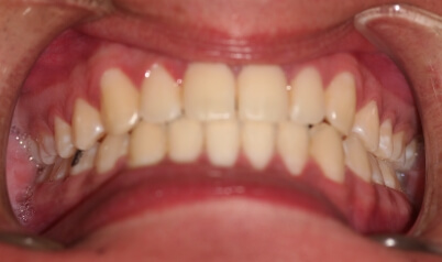 Perfected smile after orthodontic treatment