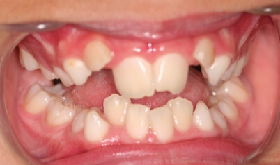 Severely misaligned smile before orthodontic treatment