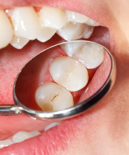 Dentist examining child's smile after dental sealant application