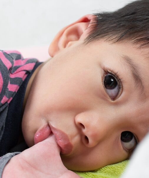 Child sucking thumb before intervention for non nutritive habits