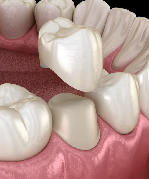 Animated smile during dental crown placement