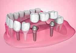 Illustration of dental implants with bridge