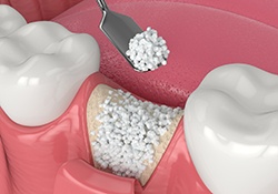 3D render of a bone graft