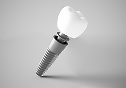 3D render of a dental implant