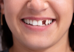 Smile with one missing tooth
