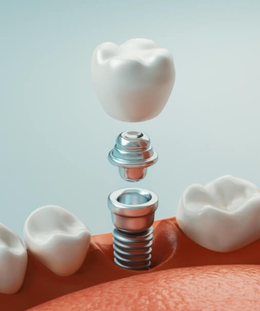 Animated smile during dental implant supported dental crown placement