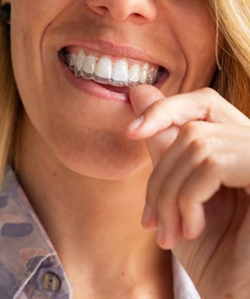 smiling woman wearing an Invisalign tray 