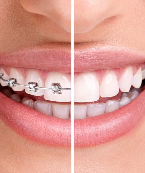 Closeup of smile before and after traditional orthodontics treatment