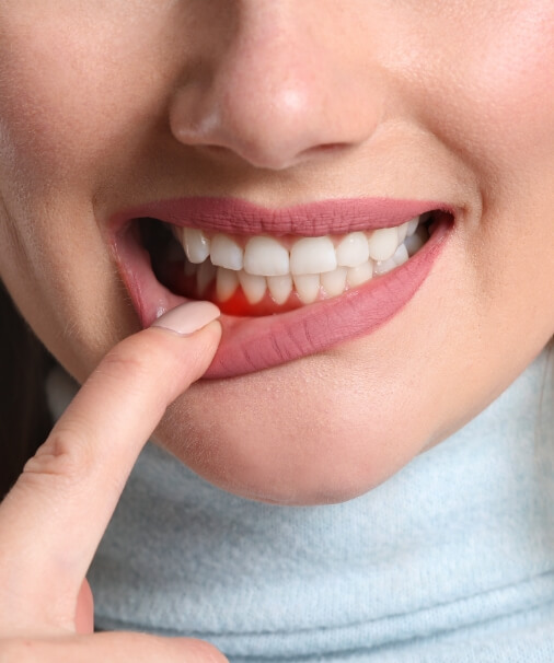 Patient with inflamed soft tissue indicative of gum disease