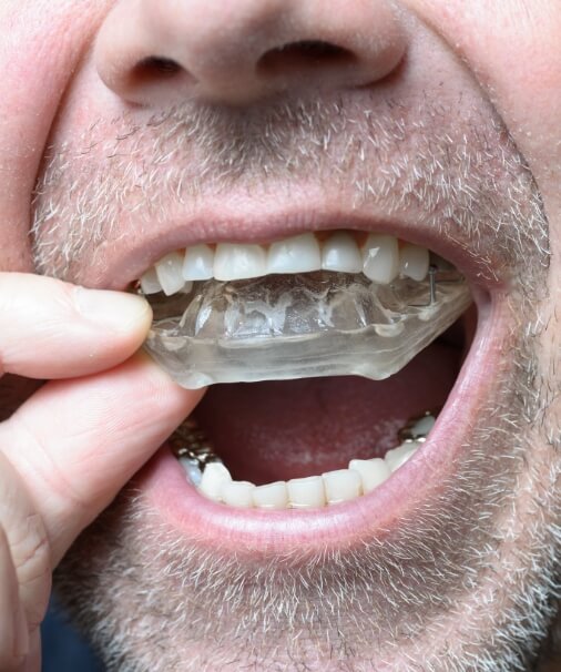 Man placing nighguard for bruxism