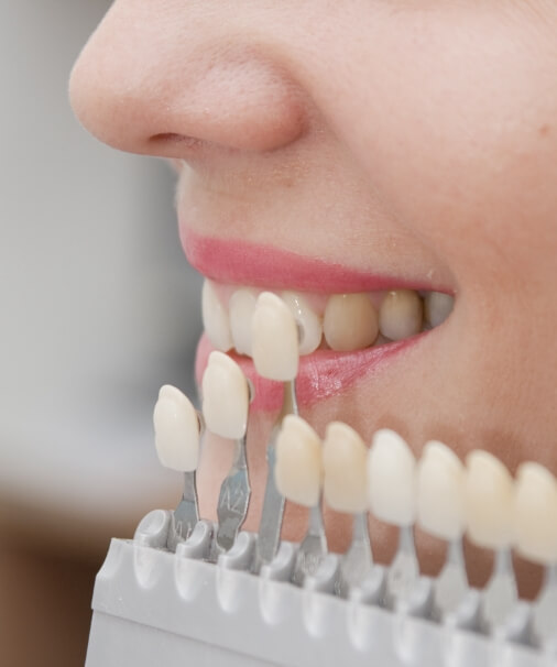 Smile compared with tooth colored filling shade chart