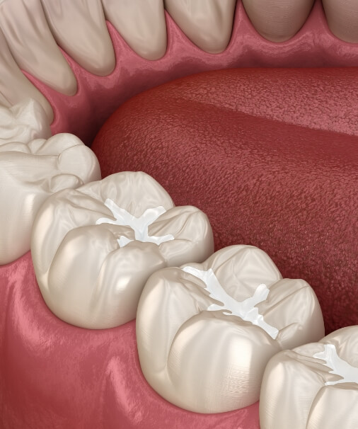 Animated smile with dental sealants in place