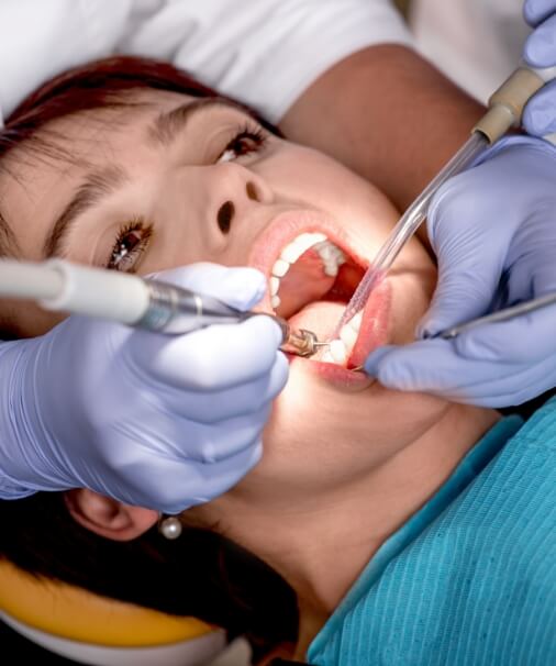 Dentist placing dental sealants