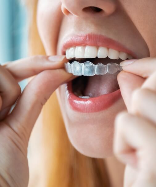 Patient placing a custom fitted oral appliance