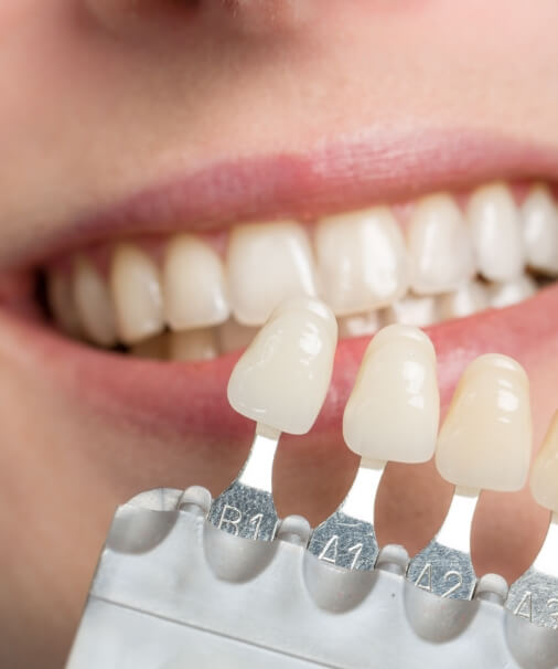 Smile compared to porcelain veneer color options