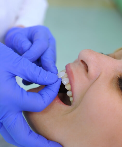 Dentist placing porcelain veneers