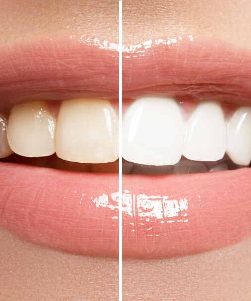 Smile before and after teeth whitening