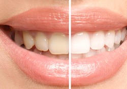 Before and after teeth whitening