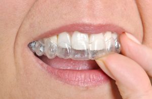 clear braces for straightening treatment