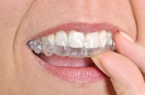 clear braces for straightening treatment