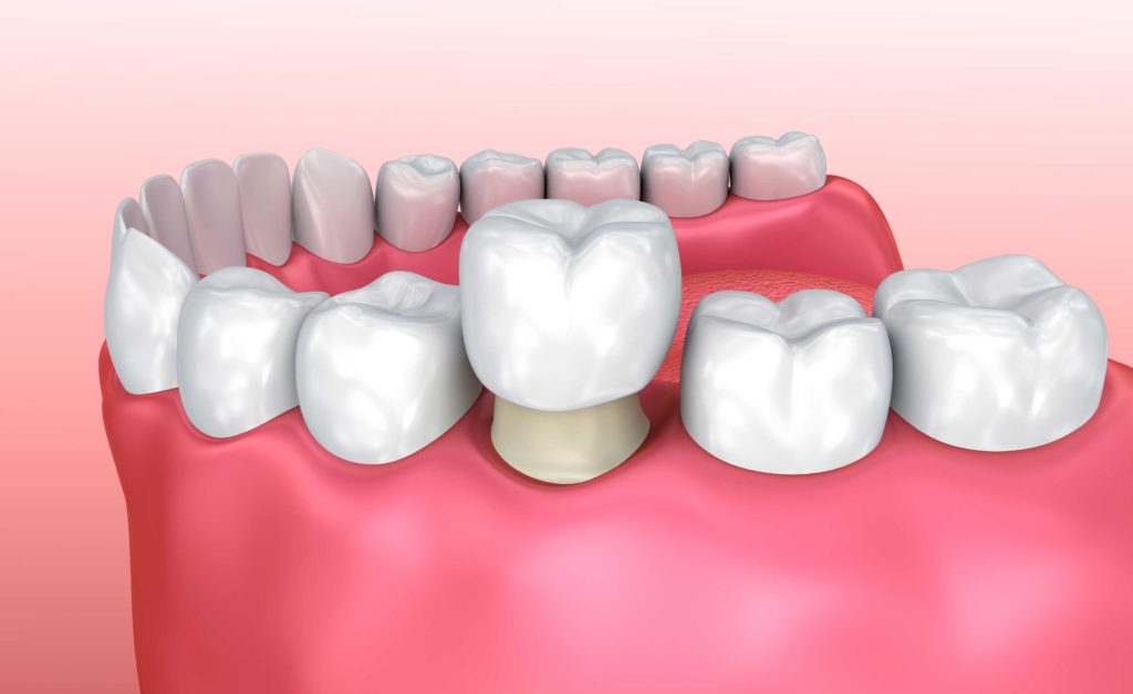 Digital image of a dental crown