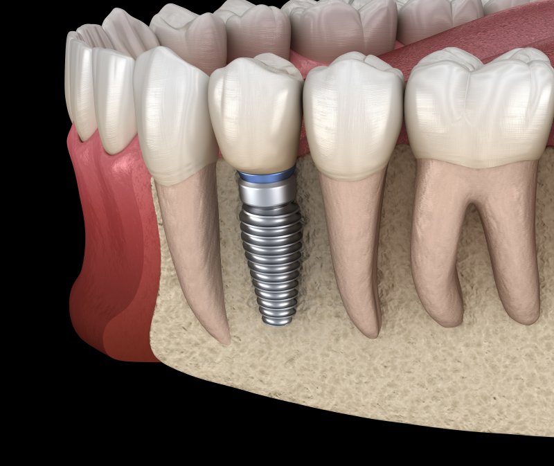 Dental implant in jaw