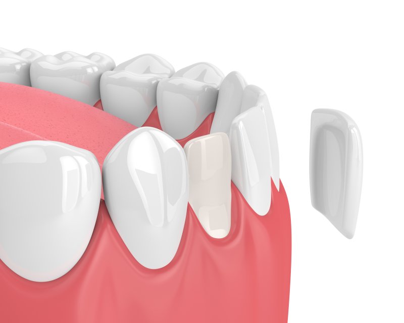 A diagram of a porcelain veneer being placed onto teeth.