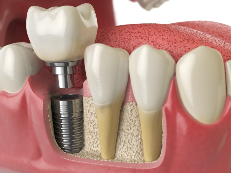 Model of dental implant sitting in jawline